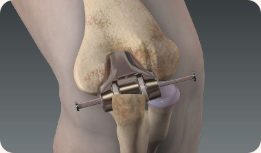 Elbow Replacement