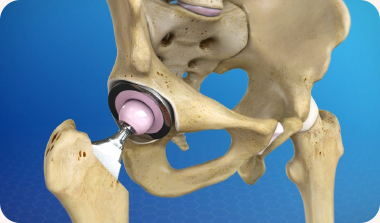 Hip Replacement